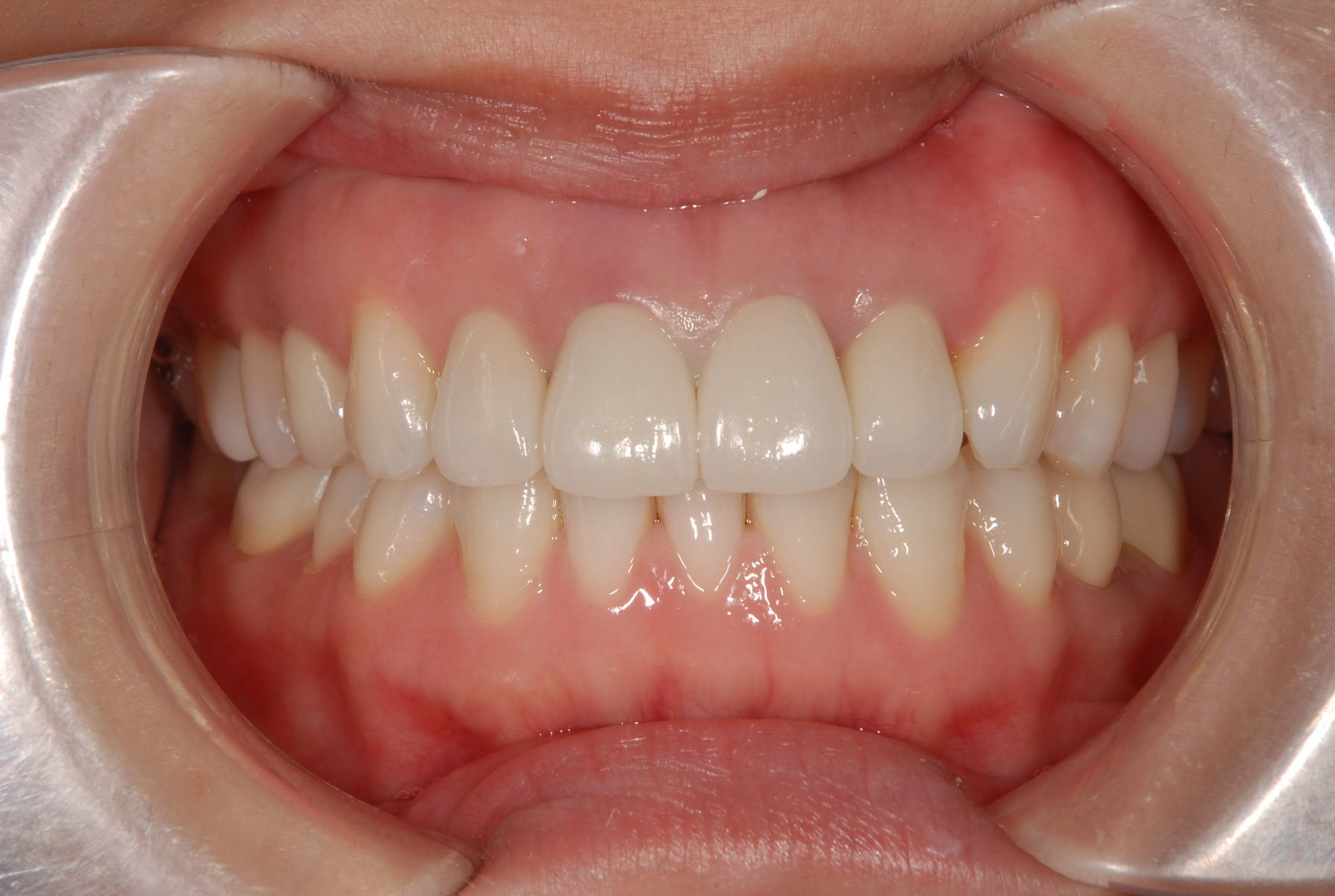 《案例分享》骨性一級、虎牙、擁擠、中線歪斜、微笑性牙齦、根管治療、協同治療、全瓷冠